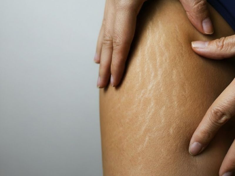 prikaz strija na koži