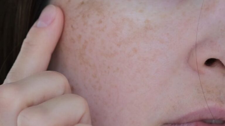 devojak pokazuje pigmentaciju na licu