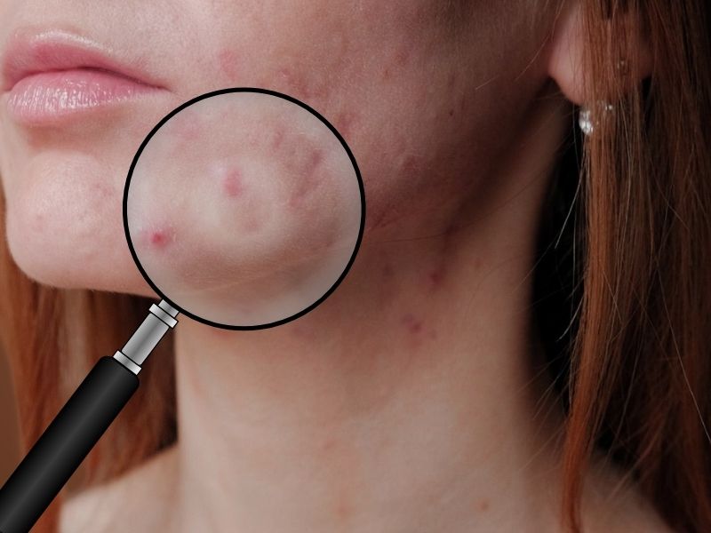 prikaz devojke sa perioralnim dermatitisom i lupom na njenim bubuljicama