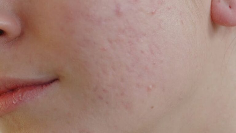 Ožiljci od akni – Kako ih ukloniti i Da li prirodna ulja pomažu?