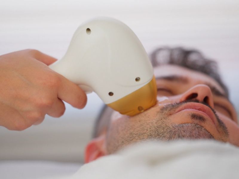 momak na laserskom tretmanu za uklanjanje pigmentacije se lica