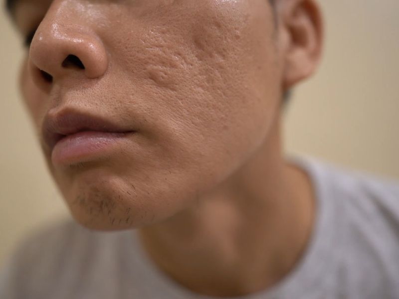 momak gleda u ogledalu svoje ožiljke na licu