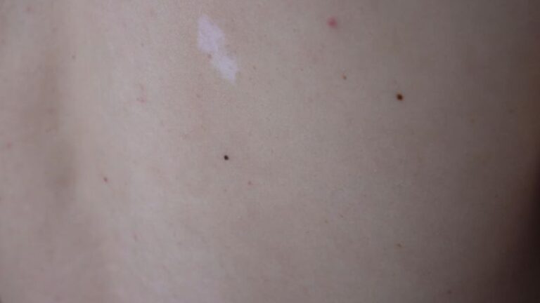 prikaz mladeža na leđima