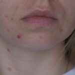 devojka sa perioralnim dermatitisom