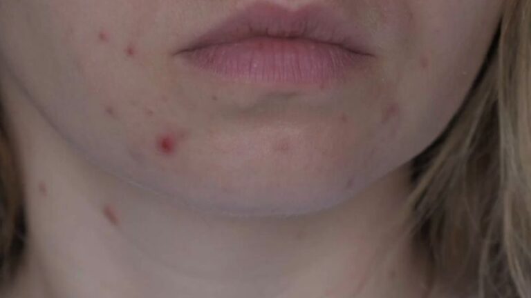 devojka sa perioralnim dermatitisom