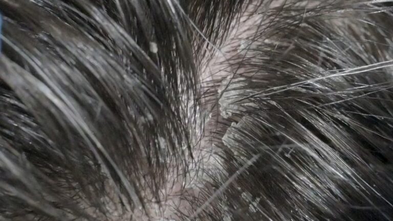 Kako se rešiti peruti prirodnim putem? Efikasni tretmani kod kuće