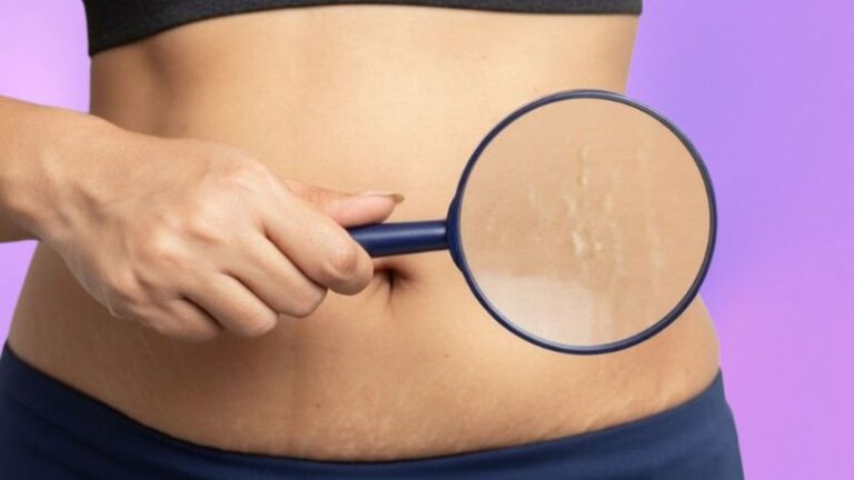 Kako ukloniti strije? Laserski tretmani vs. kreme – šta je efikasnije?